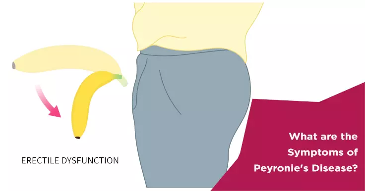 Peyronie’s Disease Symptoms: What It Means for Male Fertility