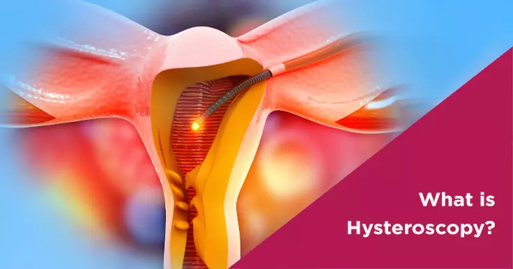 What Is Hysteroscopy? Understand its Procedure