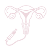 Hysterosalpingogram (HSG)