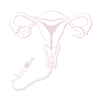 Hysterosalpingography (HSG) Test