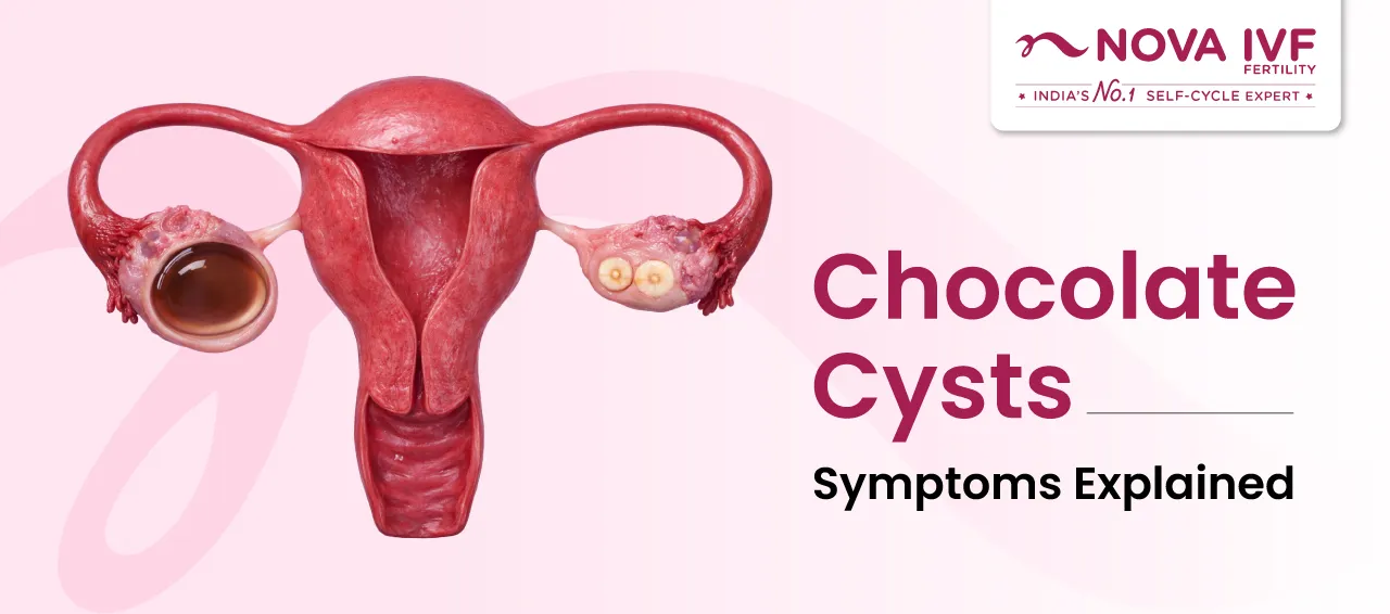 Chocolate Cysts Symptoms Explained