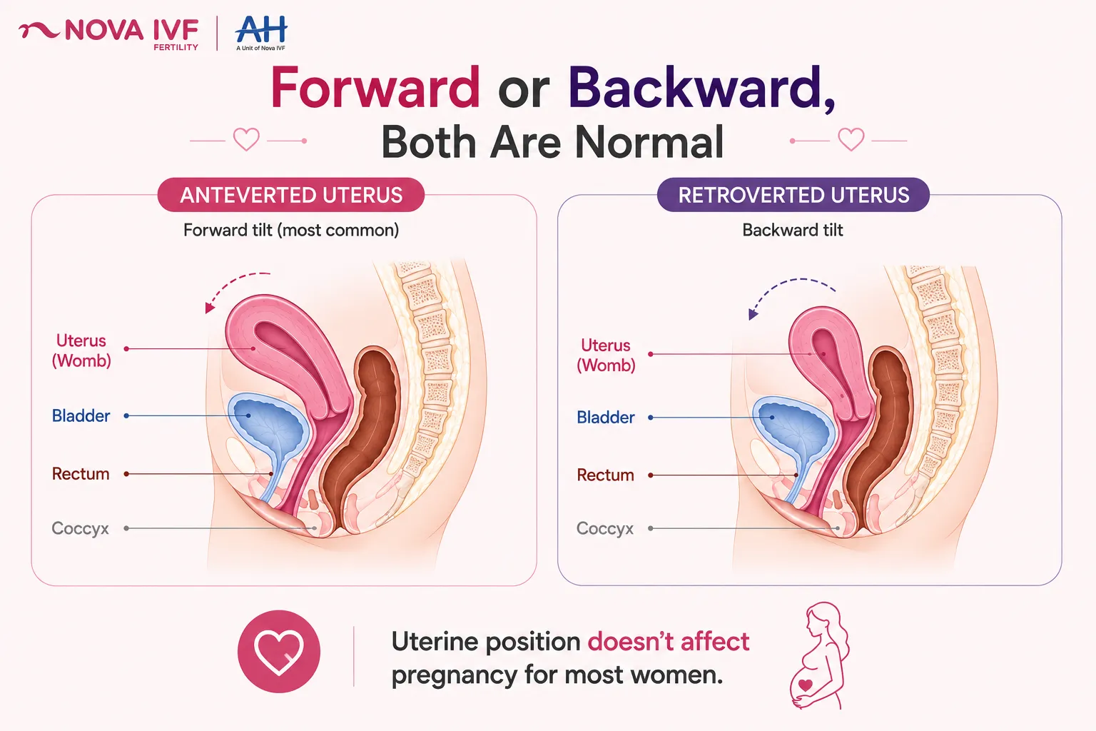Anteverted Uterus Pregnancy Explained: Bump Changes, Best Positions, and What to Expect
