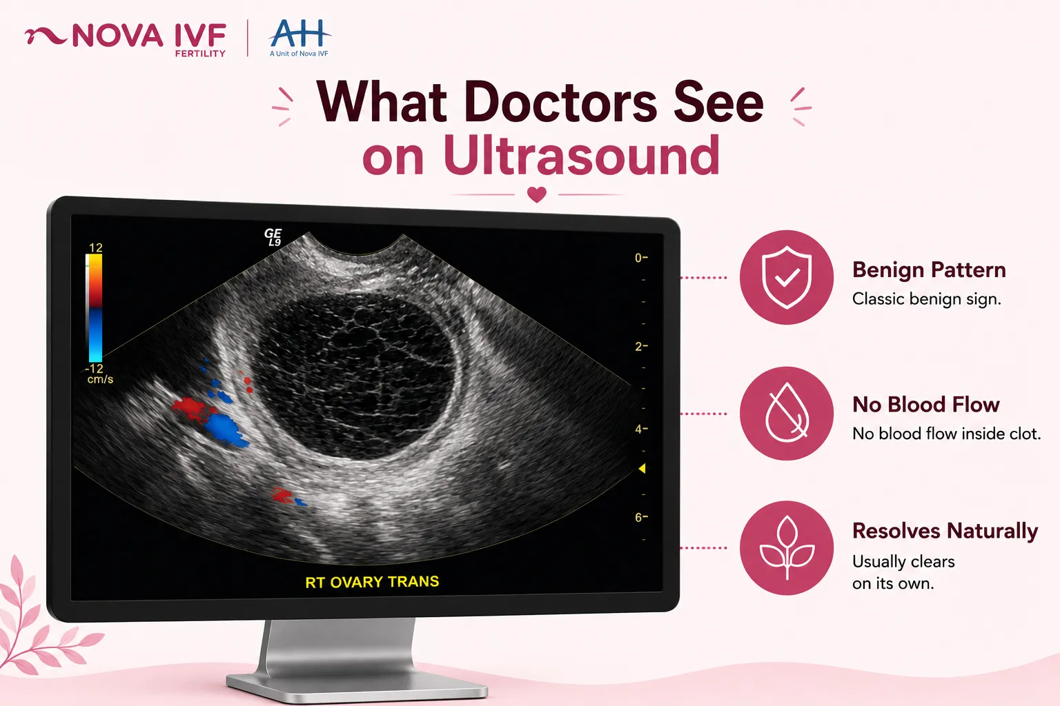 Hemorrhagic Follicle in Ovary: What It Is, Symptoms, and Effect on Pregnancy