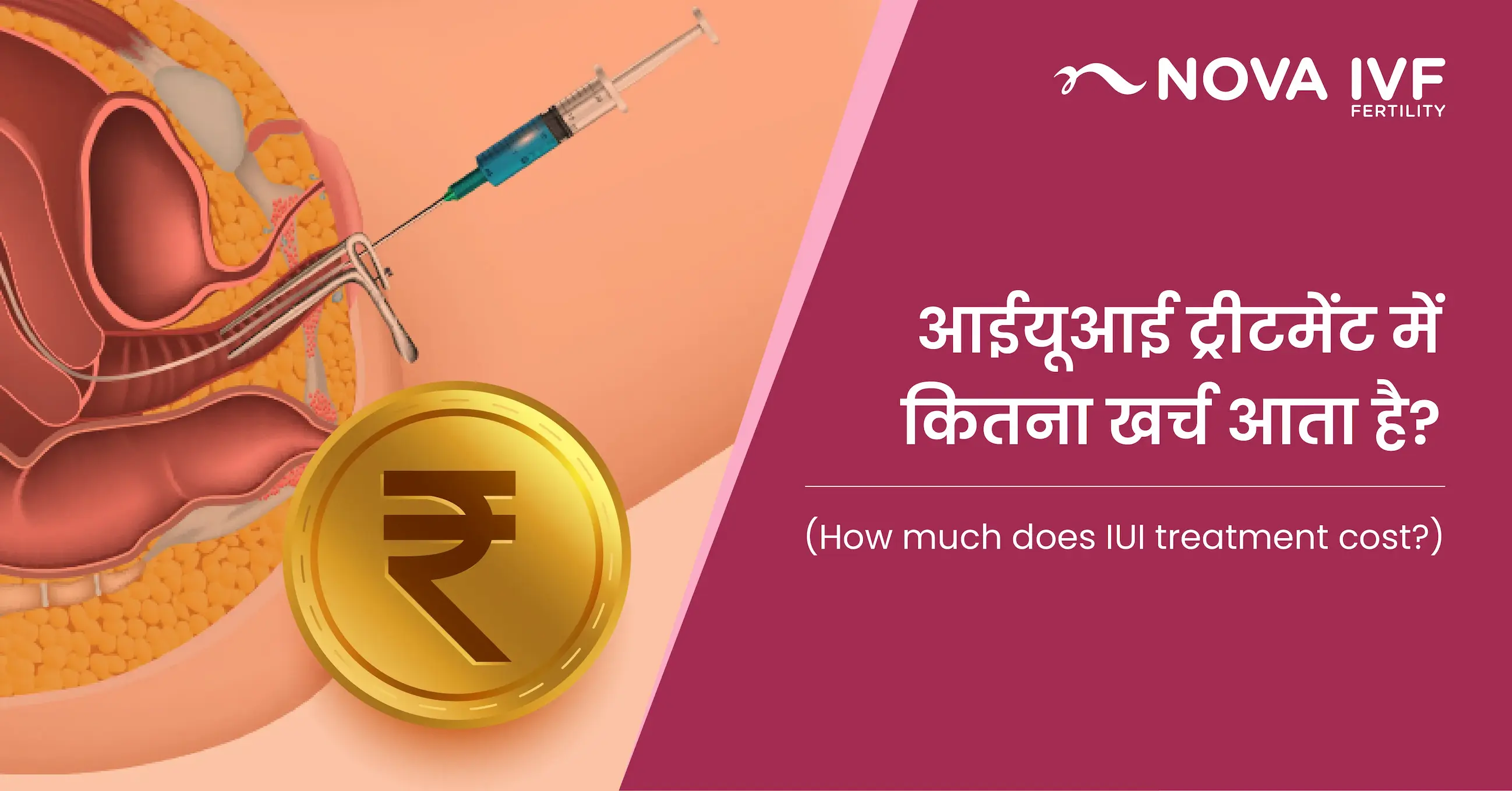 आईयूआई ट्रीटमेंट में कितना खर्च आता है? (How Much Does IUI Treatment Cost in Hindi) 