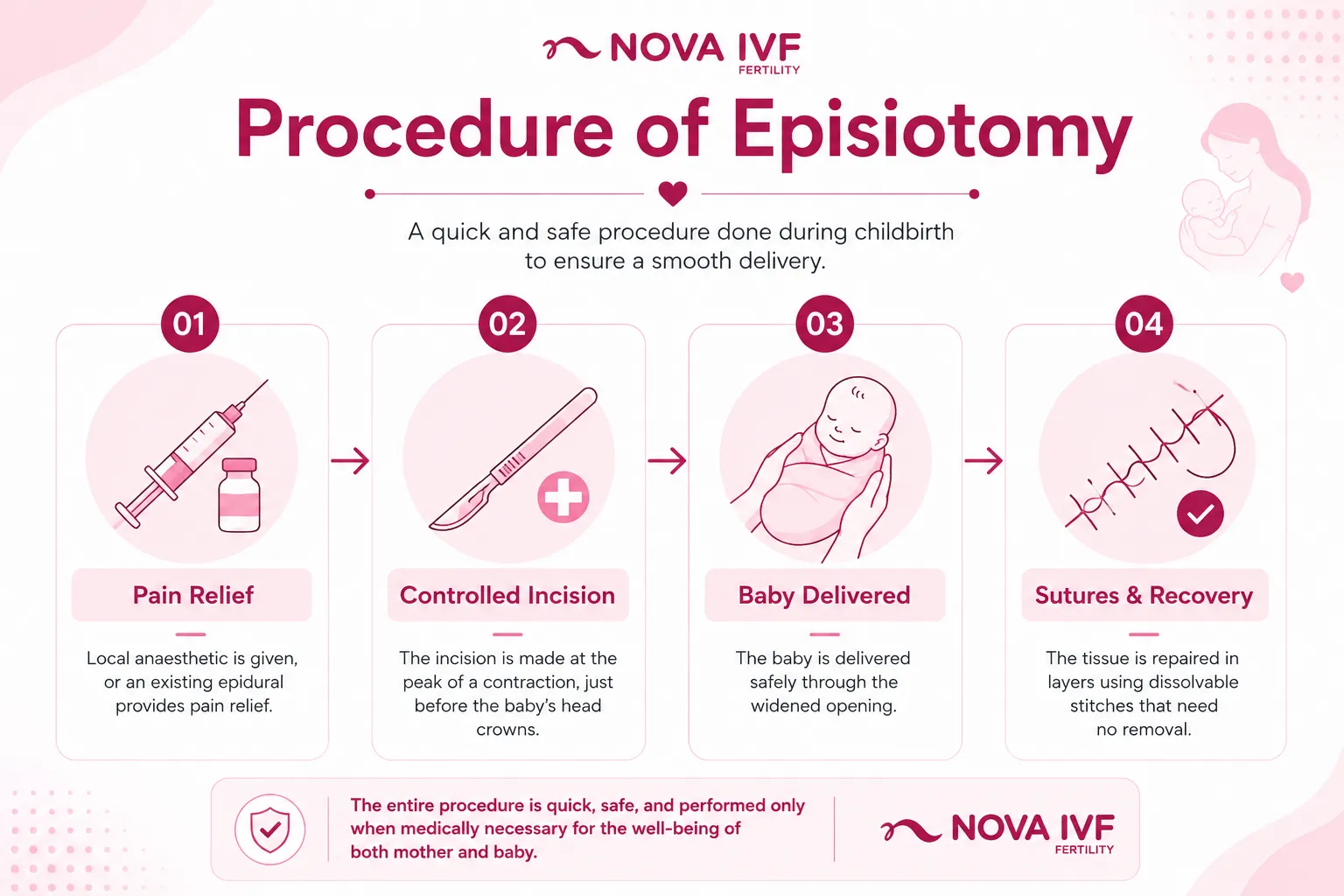 4 Types of Episiotomy: What Every Expecting Mother Should Know